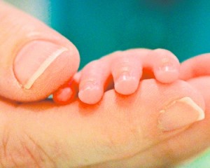prematuridade